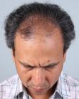 Before Hair Transplant&nbsp;Front